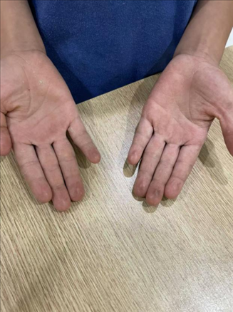 9歲小學(xué)生長(zhǎng)期拍煙卡，手部粗糙長(zhǎng)繭。受訪(fǎng)者供圖